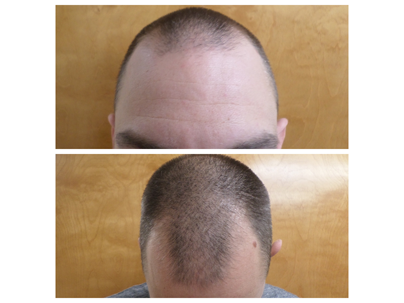 Get the Facts about Hair Transplantation in New York post thumbnail image
