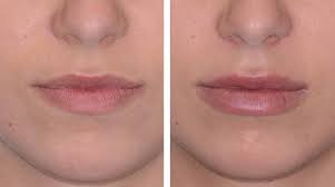 Aftercare Guidelines Following Lip Fillers Santa Barbara Treatment post thumbnail image