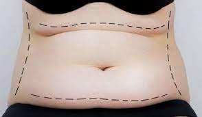 Restore Your Body Shape with a Tummy Tuck in Miami post thumbnail image